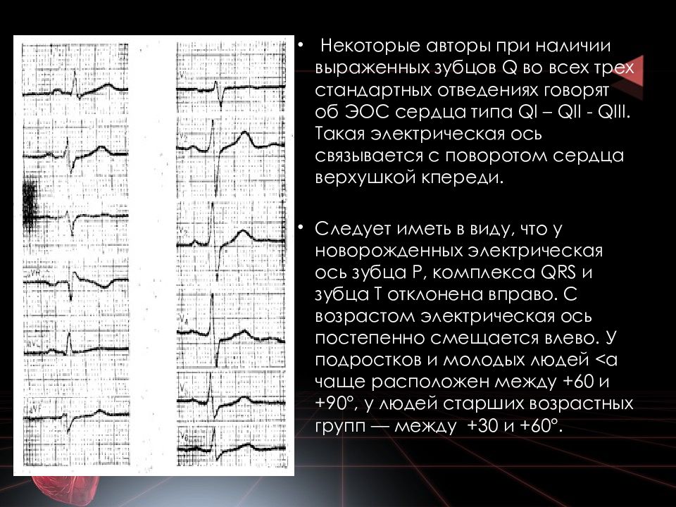 Низкоамплитудные отведения экг