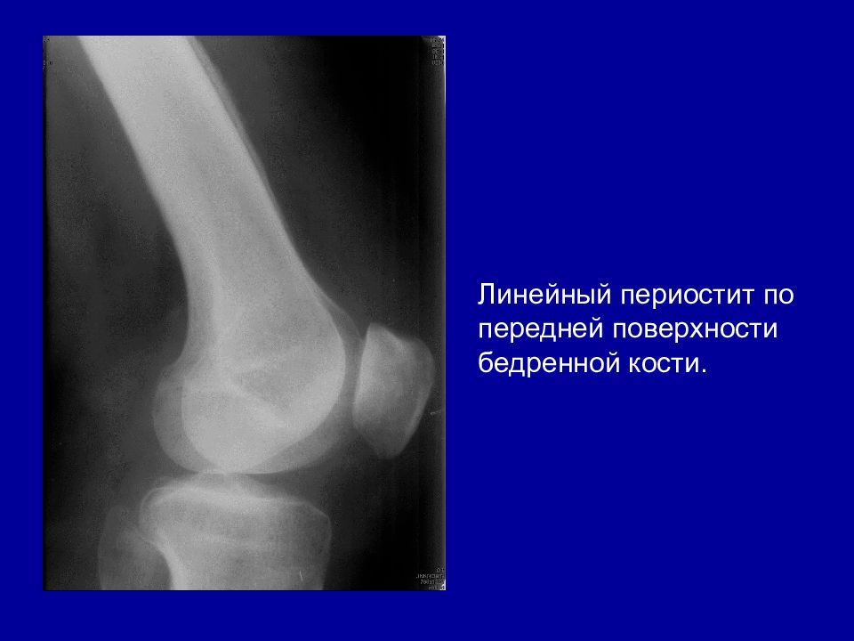 Ушиб надкостницы. Периостит большеберцовой кости на рентгене. Линейный периостит большеберцовой кости. Бахромчатый периостит. Периостит коленного сустава рентген.