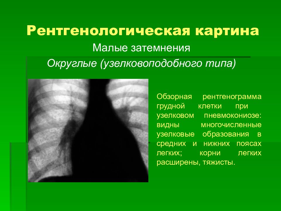 Ампутация корней легких при рентгенологической картине характерна для