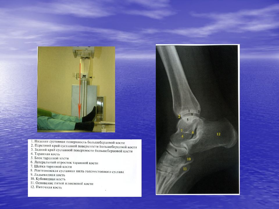 Рентгены анатомия. Большеберцовая кость рентген анатомия. Рентген длинных трубчатых костей. Рентген длинных трубчатых костей фтор и его соединения. Асептический некроз большеберцовой кости голеностопного сустава.