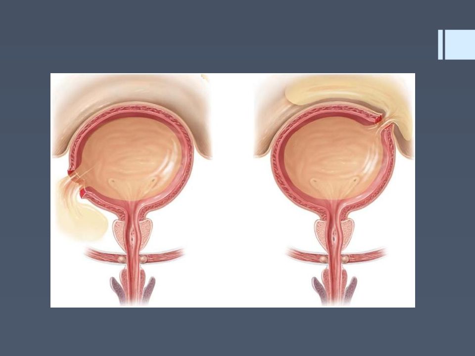 Мочевой пузырь ощущение. Лопание мочевого пузыря. Разорванный мочевой пузырь. Мочевой пузырь лопается. Повреждение мочевого пузыря клиника.