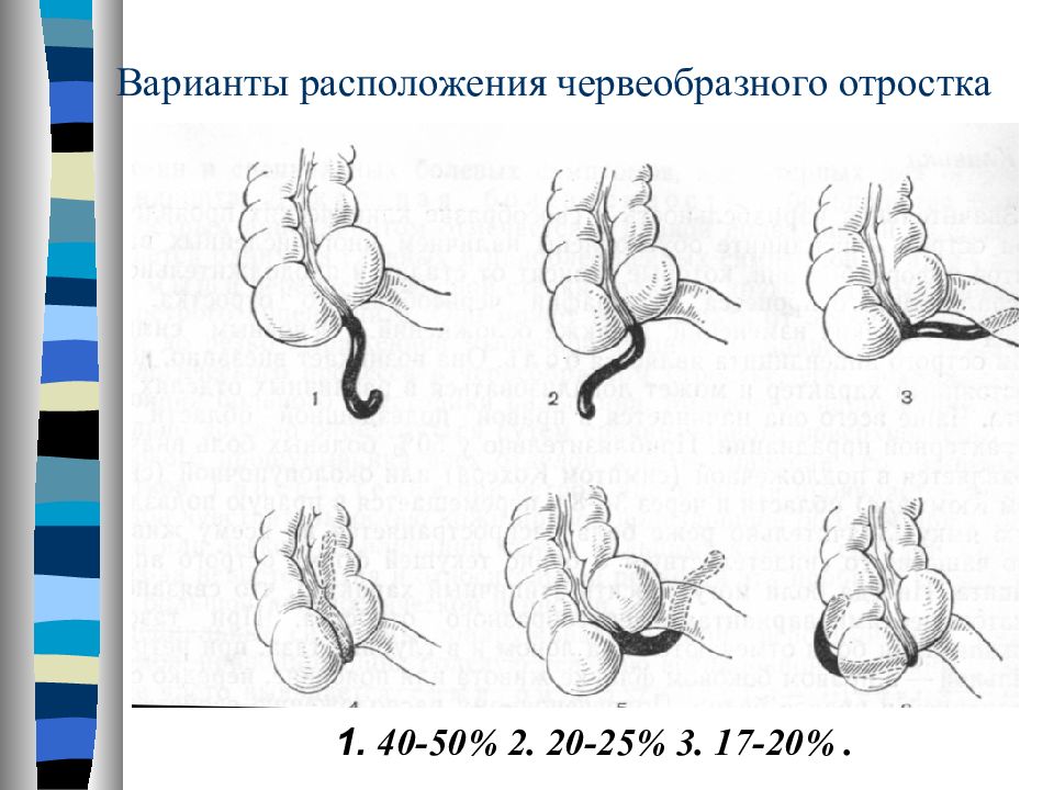 Особенности клинической картины острого аппендицита при тазовом расположении червеобразного отростка