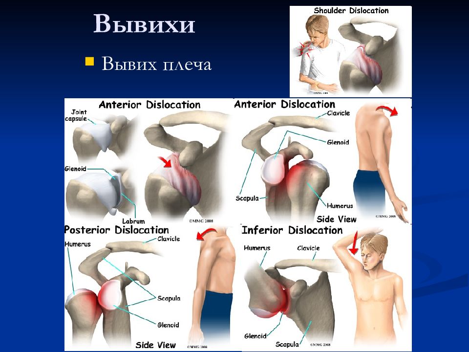 Вывих сустава плеча. Вывих плеча операция название. Классификация вывихов плечевой кости.