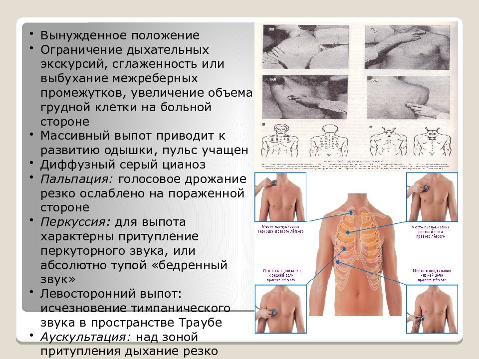 Шпаргалка скорой помощи межреберная невралгия