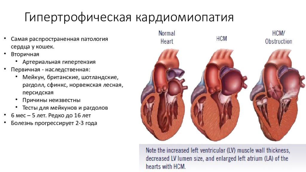 Кардиомиопатия сердца что это такое