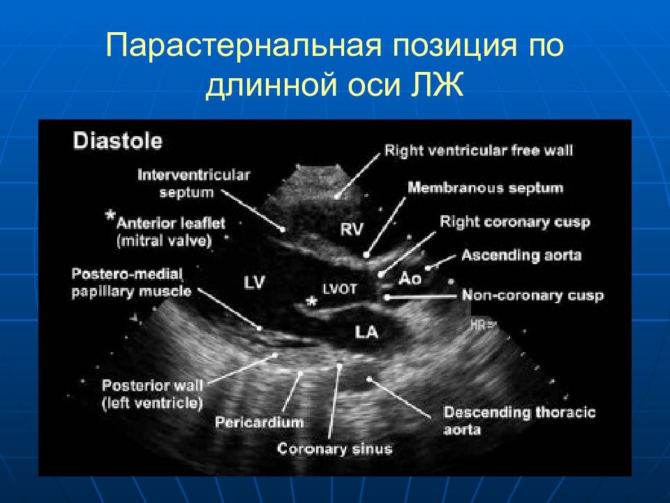 Сегменты левого желудочка на эхокг схема