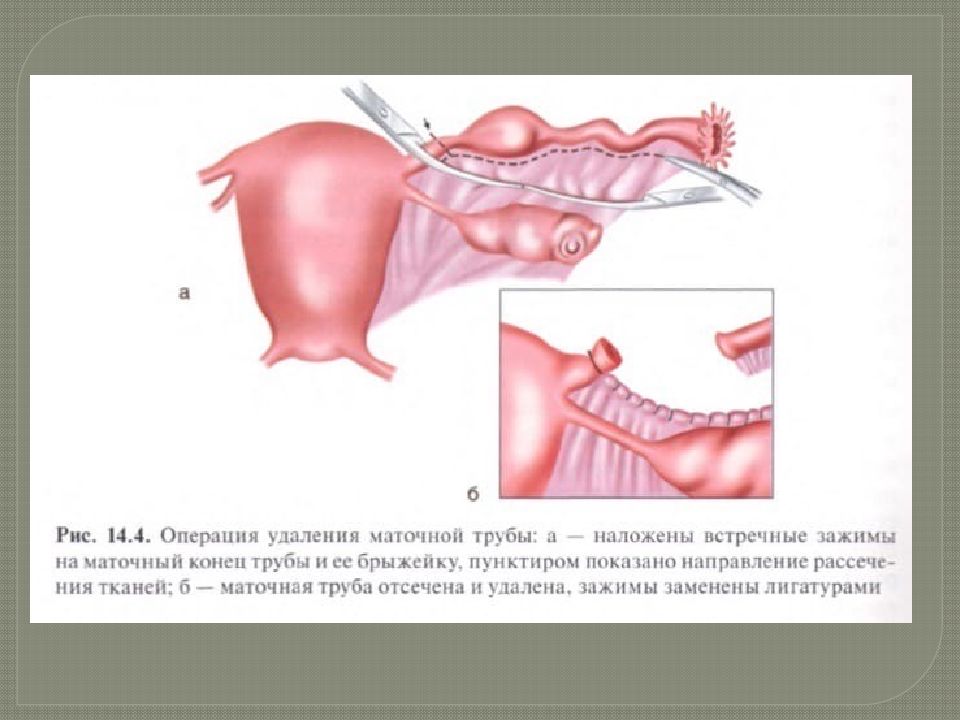 Можно рожать после внематочной беременности. Лапаротомия тубэктомия. Внематочная беременность. Операция при внематочной беременности.