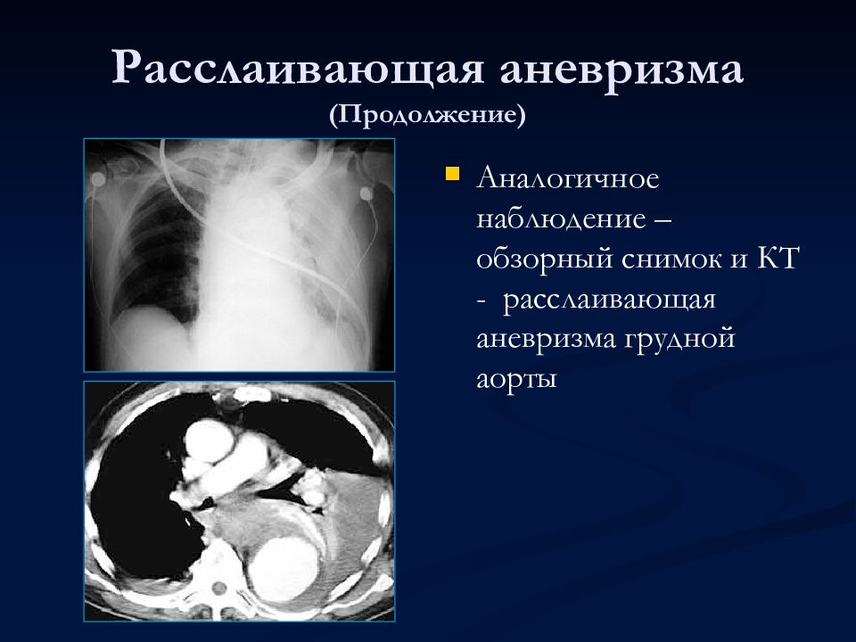 Расслаивающаяся аневризма аорты презентация