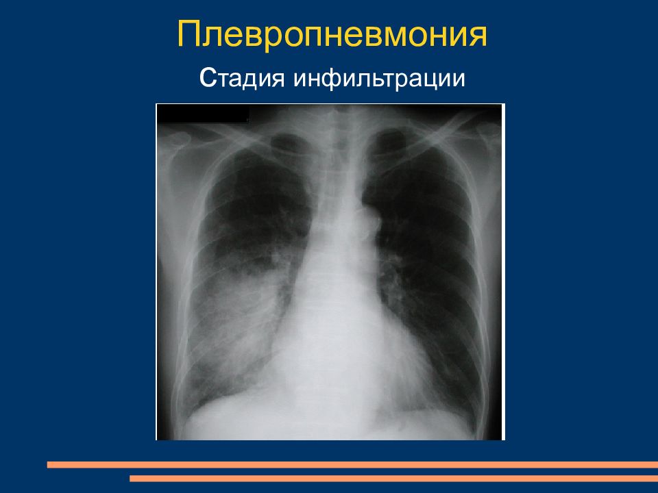 Плевропневмония. Плевропневмония рентген. Плевропневмония диагноз. Стадии плевропневмонии.