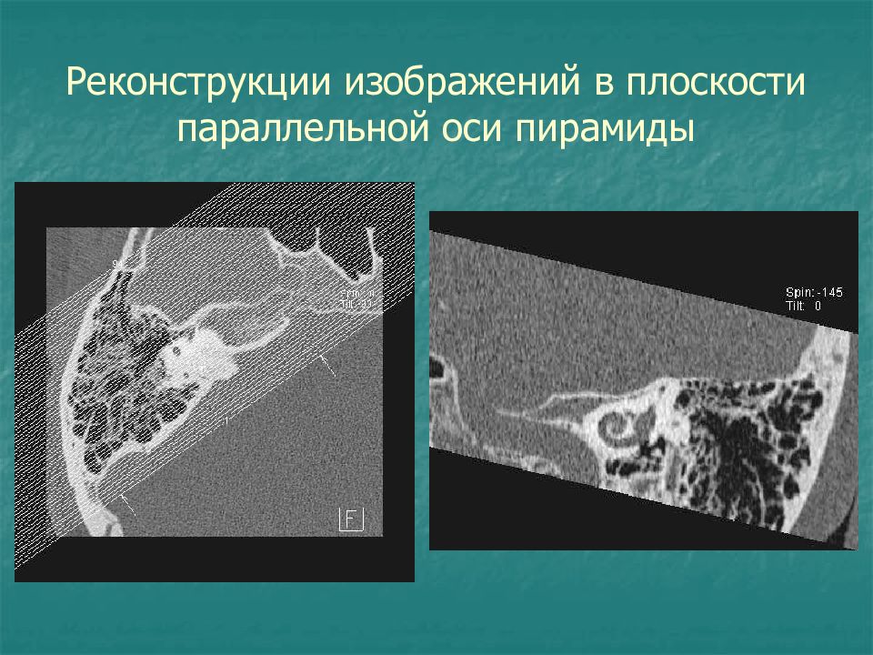 Пирамида височной кости кт. Пирамида височной кости анатомия кт. Холестериновая гранулема височной кости на кт. Пирамида височной кости на кт. Коронарная проекция кт височных костей.