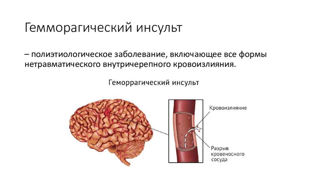 Геморрагический инсульт что это