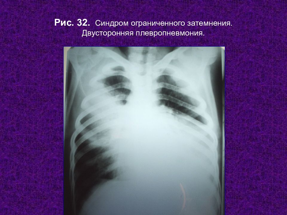 Плевропневмония. Синдром ограниченного затемнения легочного поля рентген. Ограниченное затемнение легкого. Плевропневмония на рентгенограмме. Синдром ограниченного затемнения легочного.