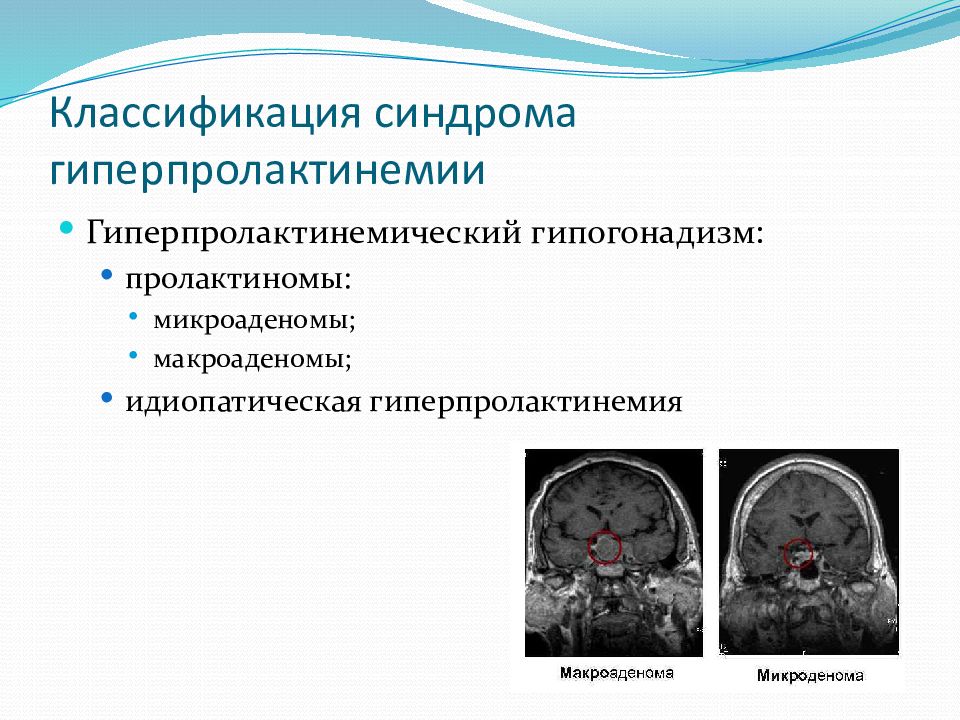 Пролактинома. Гиперпролактинемия классификация. Синдром гиперпролактинемического гипогонадизма. Классификация синдрома гиперпролактинемии. Идиопатическая гиперпролактинемия.