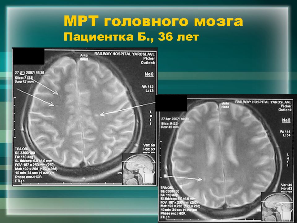 Рассеянный склероз очаги в головном. Кт мозга рассеянный склероз. Очаги рассеянного склероза на мрт. Рассеянный склероз мрт мозга. Мрт при рассеянный склероз.