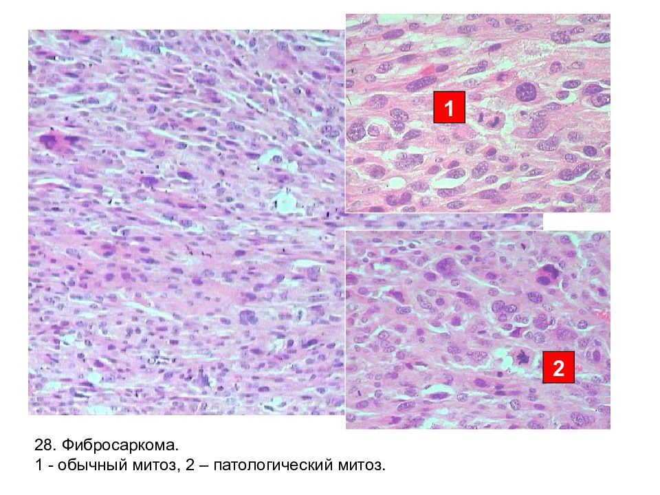 Фибросаркома. Фибросаркома препарат патанатомия. Фибросаркома гистология. Низкодифференцированная фибросаркома гистология. Фибросаркома микропрепарат.