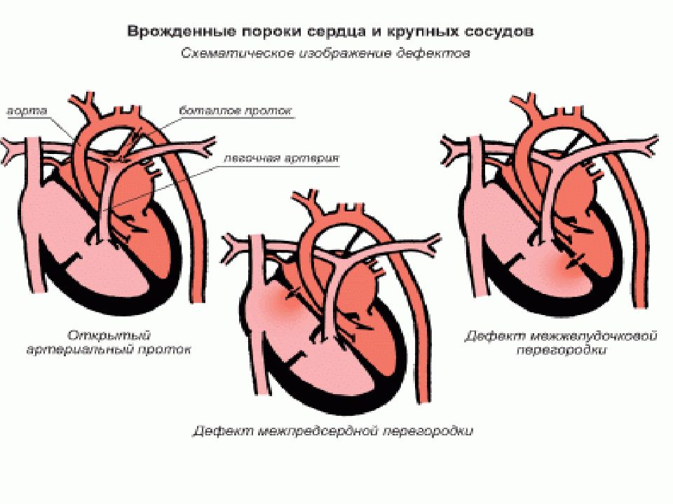 Пороков сердца клиническая картина