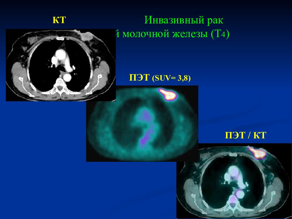 Что такое пэт кт в онкологии. SUV В ПЭТ кт.