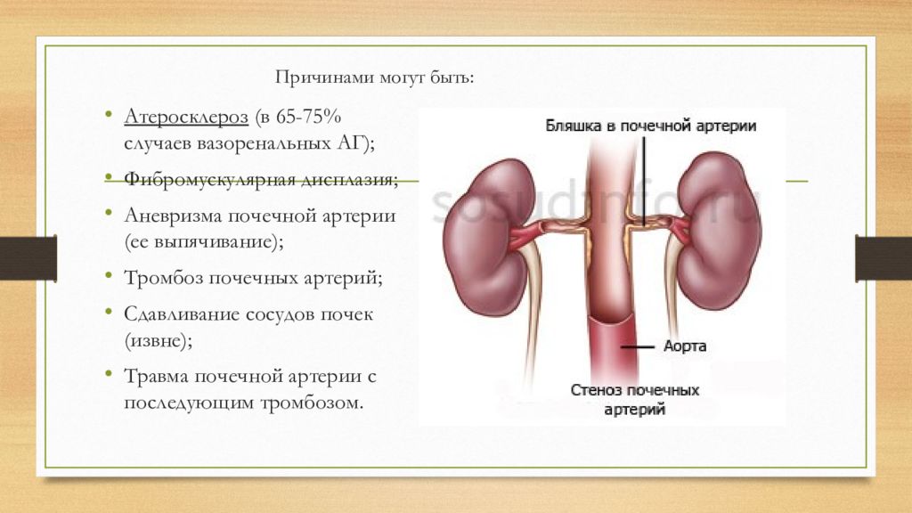 Тромбоз почечных вен. Аневризмы почечных артерий. Аневризма артерий почек. Мешотчатая аневризма почечной артерии. Аневризма аорты почечной артерии.