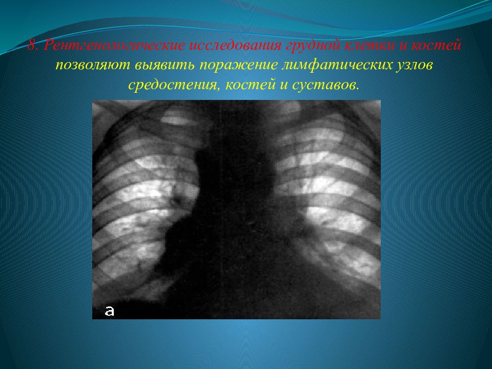 Исследование грудной клетки. Лимфатические узлы при хроническом лимфолейкозе. Лимфолейкоз рентгенограмма. Рентгенологическое исследование грудной клетки.