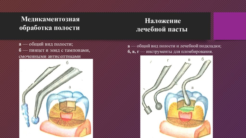 Виды полостей. Медикаментозная обработка полости. Медикаментозная обработка полости зуба. Медикаментозная обработка кариозной полости. Обработка поло.