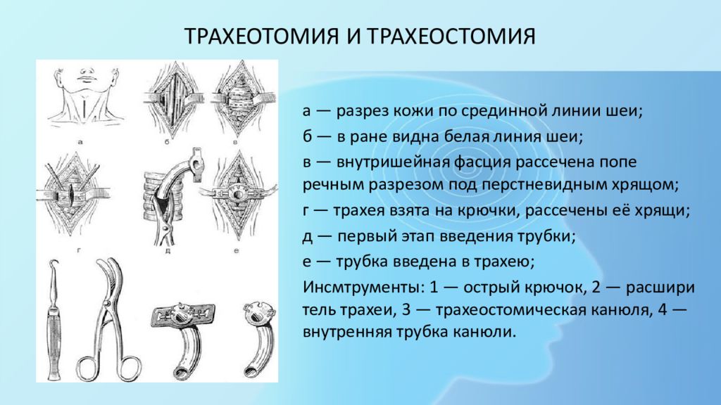 Трахеостомия. Верхняя трахеостомия Оперативная хирургия. Трахеотомия и трахеостомия. Трахеостомия методика проведения. Трахеостомия ход операции.