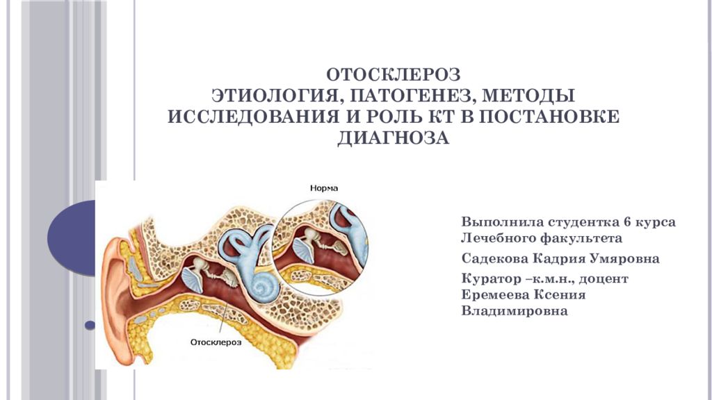 Отосклероз по утвержденным клиническим рекомендациям. Отосклероз на кт височных костей. Тимпанальный отосклероз. Отосклероз этиология. Отосклероз патогенез.