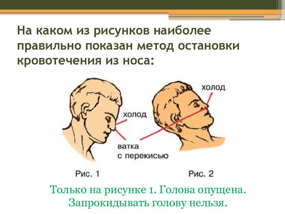 Нос затылок. Способы остановки кровотечения из носа. При кровотечении из носа нельзя запрокидывать голову. Правильный метод остановки кровотечения из носа. Способы остановки носового кровотечения.