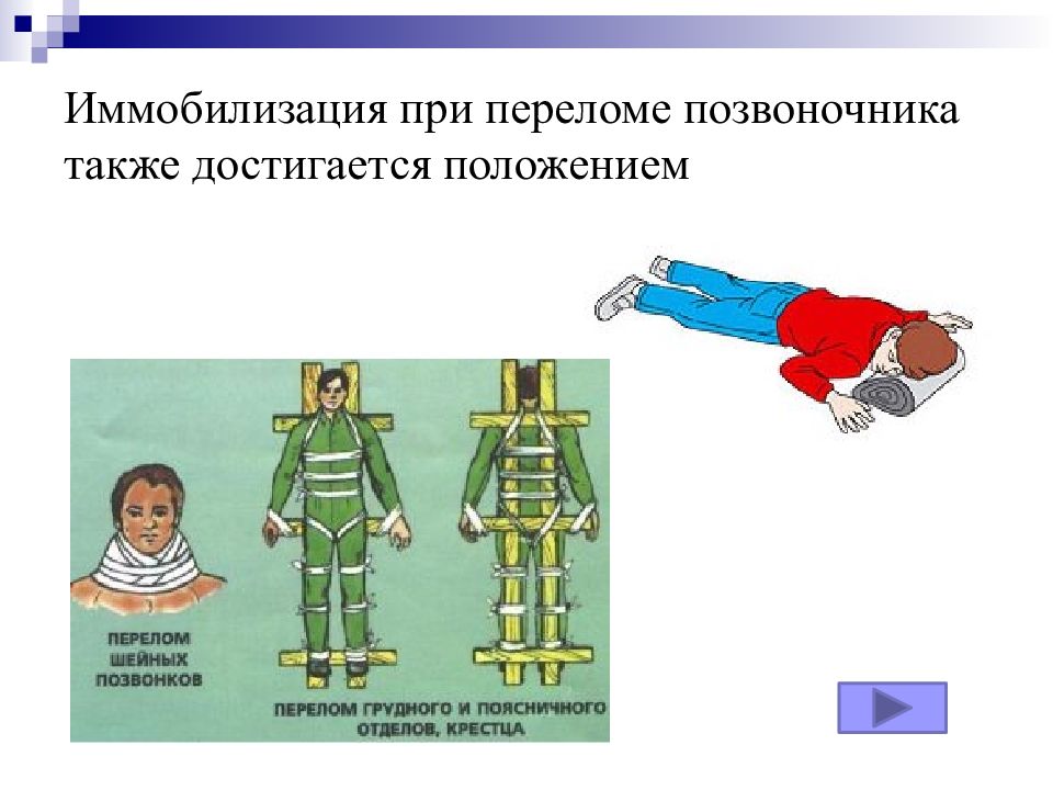 Иммобилизация при переломе. Транспортная иммобилизация при переломе позвоночника алгоритм. Перелом поясничного отдела позвоночника иммобилизация. Иммобилизация при переломе позвоночника. Мобелизация при переломе позвоночника.