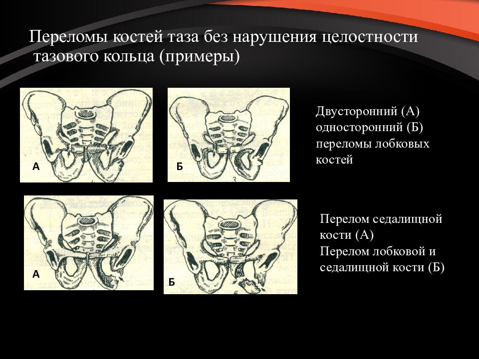 Переломы таза у детей презентация