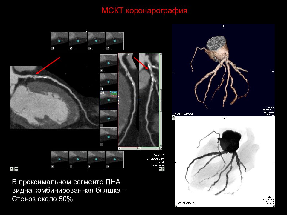 Подготовка к коронарографии. Коронарография стеноз ПНА. Проксимальный стеноз ПНА. Проксимальный сегмент ПНА.