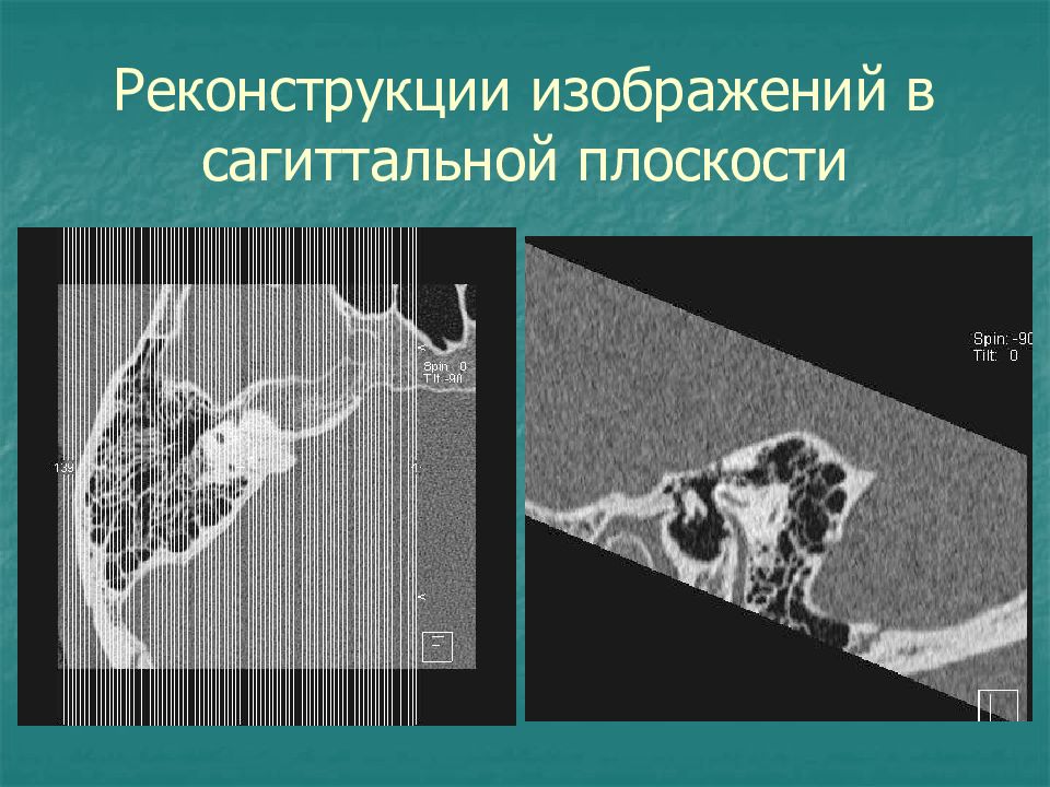 Реконструкция изображений в компьютерной томографии