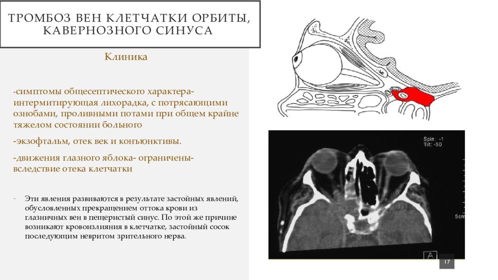 Тромбоз кавернозного синуса. Тромбоз вен клетчатки орбиты, кавернозного синуса. Тромбоз кавернозного синуса клиника. Тромбоз кавернозного синуса клинические рекомендации. Тромбоз кавернозного синуса у детей презентация.