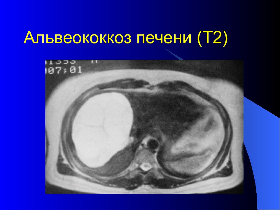 Альвеококкоз. Альвеококкоз печени кт. Альвеококкоз печени рентген.