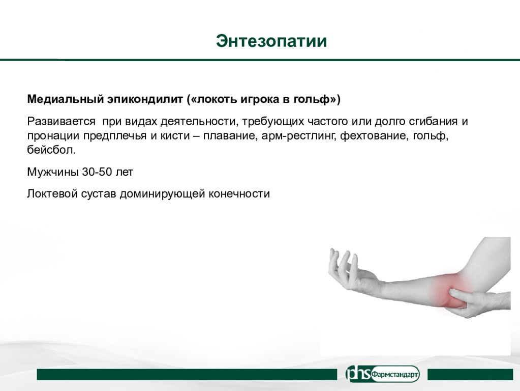 Энтезопатия что это такое. Энтезит сухожилий локтевого сустава. Энтезопатия сухожилия локтевого сустава.