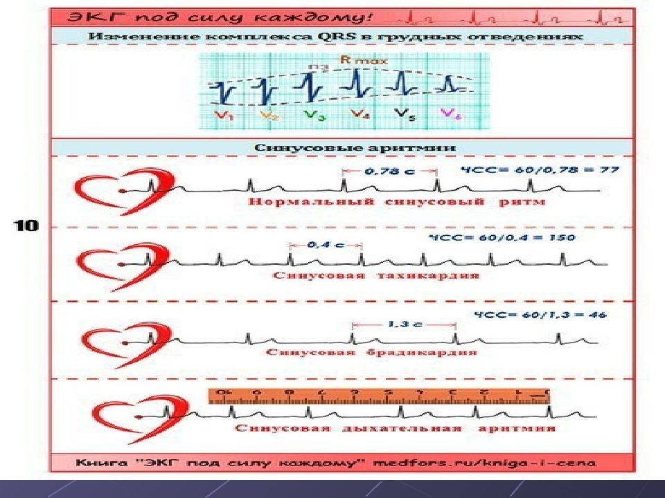 Аритмии и блокады сердца презентация
