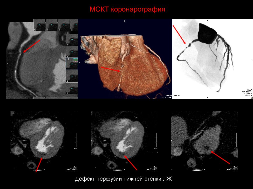 Окклюзия пка. Мультиспиральная компьютерная томография коронарография. Коронарография окклюзия ПКА. МСКТ коронароангиография.