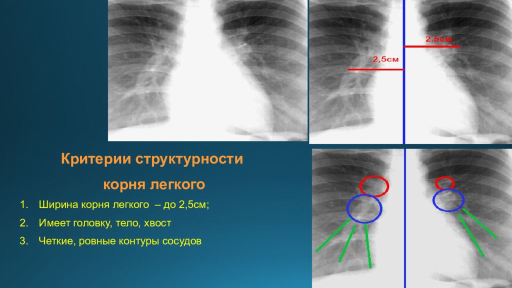 Расширение легких. Корни легких на рентгене. Корни лёгких на рентгенограмме. Кореь легко на рентгене.