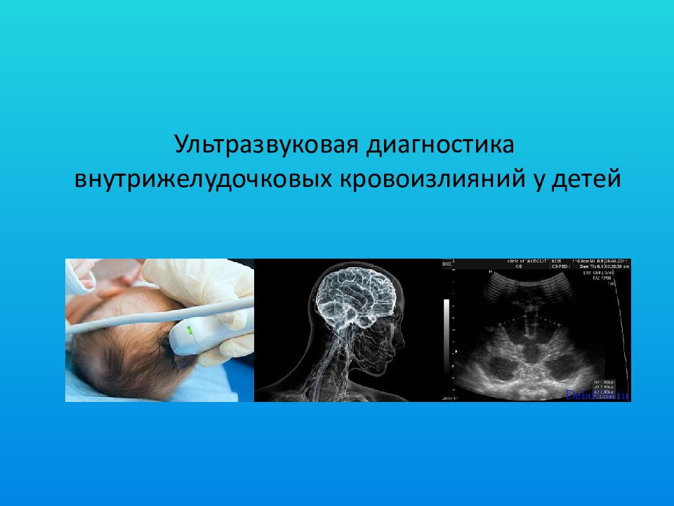 Ультразвуковая диагностика внутрижелудочковых кровоизлияний у детей