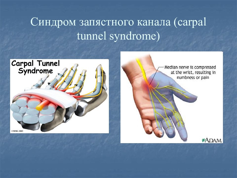Код мкб синдром запястного канала. Синдром запястного канала. Топография запястного канала. Карпальный канал топография. Синдром запястного канала лечение.
