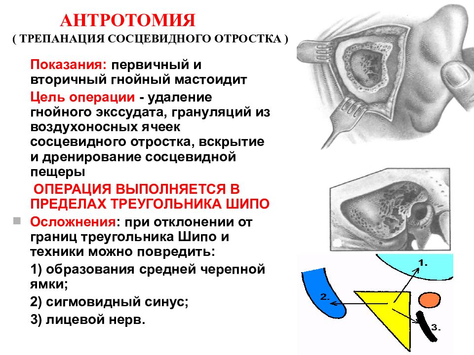 Стенки сосцевидного отростка