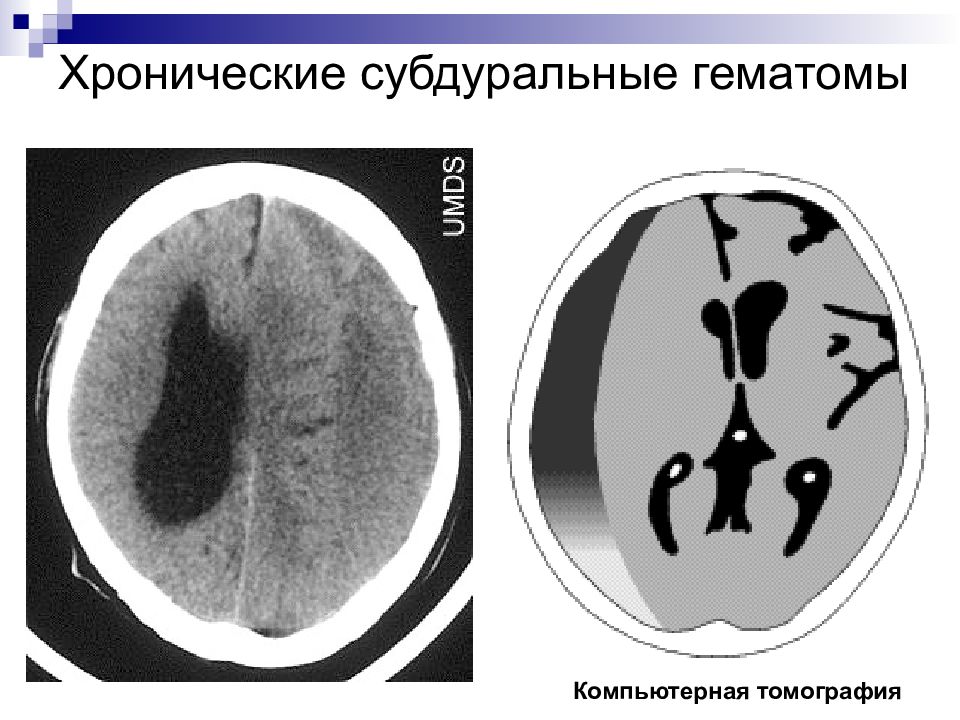 Субдуральная гематома. Хронические субдуральные гематомы на кт. Хроническая субдуральная гематома на кт. Подострая субдуральная гематома кт. Пластинчатая субдуральная гематома кт.