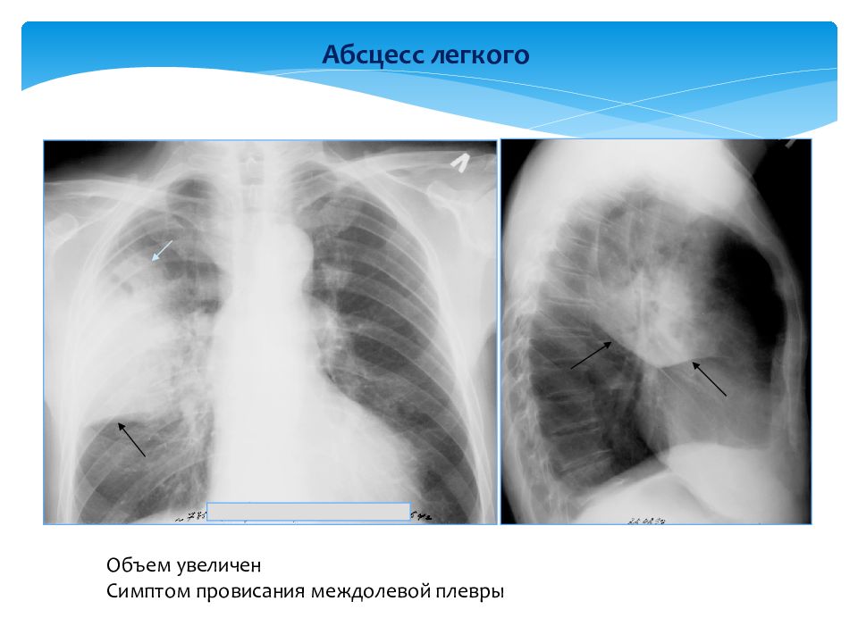 Абсцесс легкого. Абсцесс верхней доли правого легкого. Абсцесс средней доли правого легкого. Абсцесс легкого причины. Абсцесс нижней доли легкого.