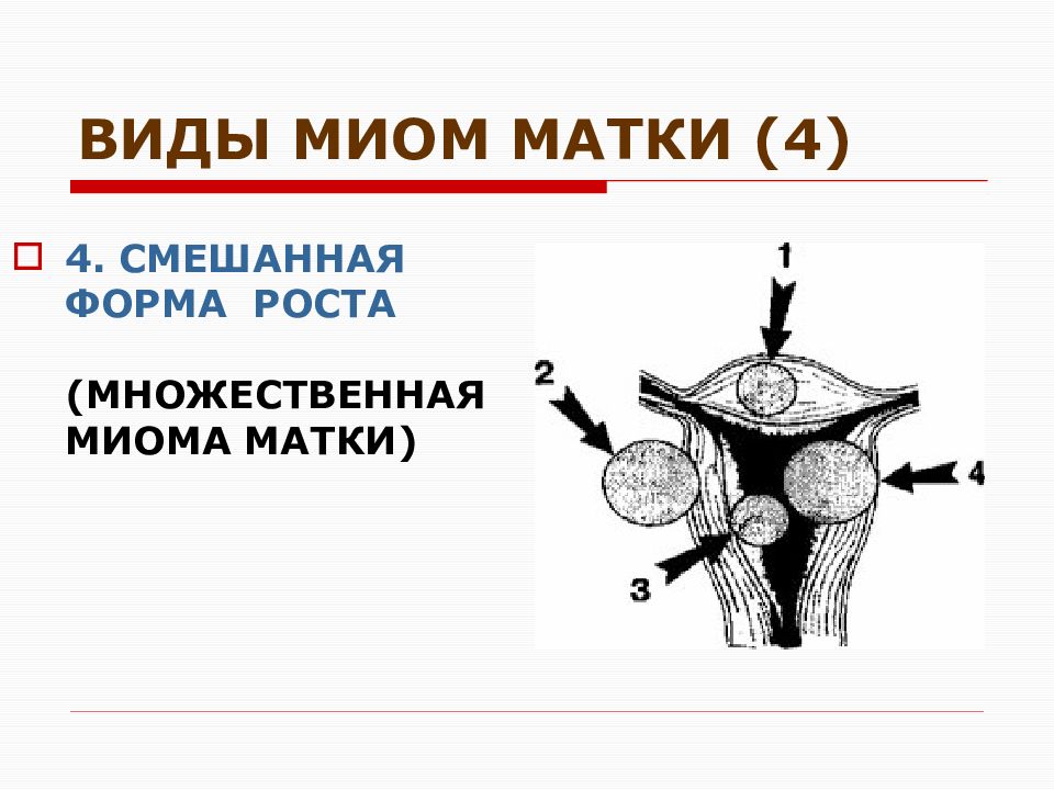 Виды маток. Множественная миома матки. Вылущивание миомы матки.