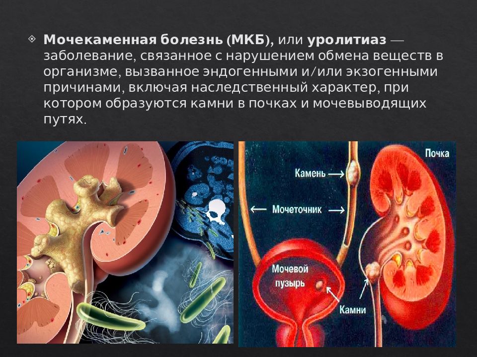 Почечнокаменная болезнь презентация