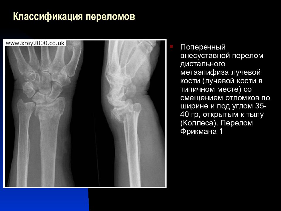 Образец описания рентгенограммы перелома