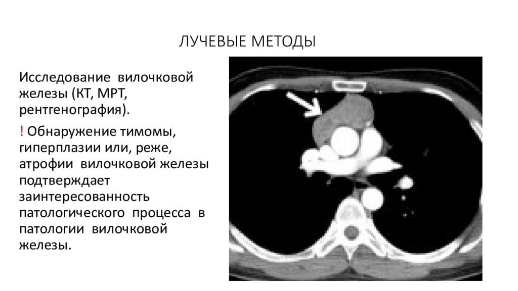 Лучевая железа. Остаточная ткань вилочковой железы на кт. Тимома вилочковой железы мрт. Кт средостения при миастении.