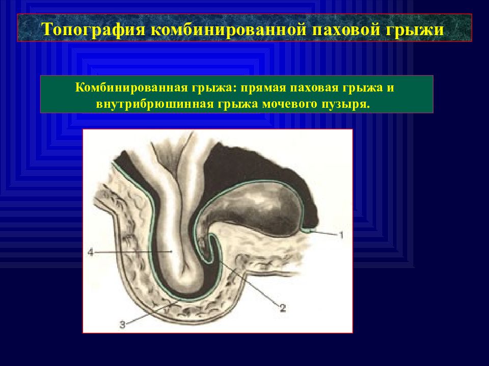 Мошоночная грыжа. Скользящая грыжа мочевого пузыря. Комбинированная паховая грыжа. Скользящая прямая паховая грыжа.