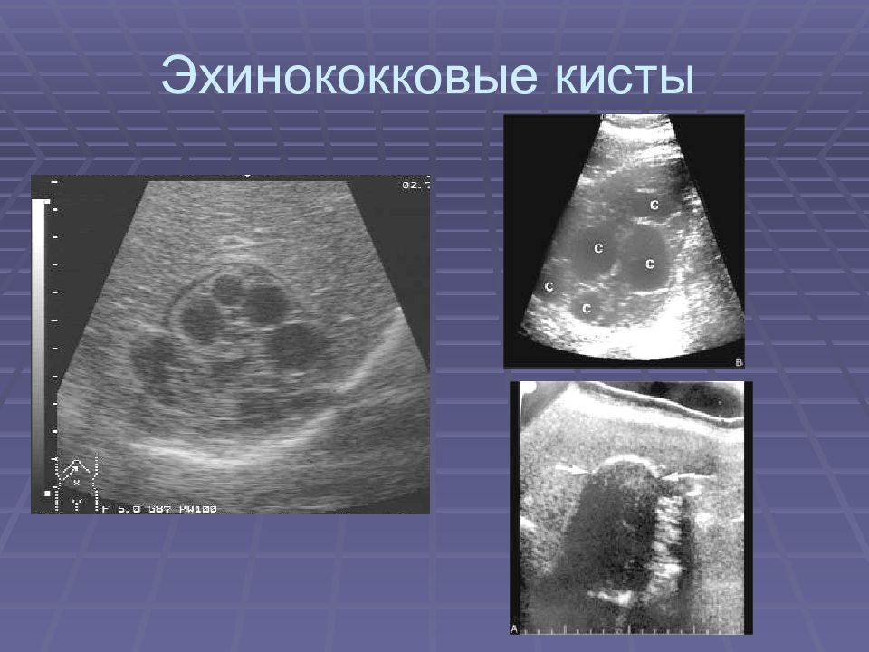 Киста печени. УЗИ картина эхинококковой кисты печени. Эхинококковая киста селезенки на УЗИ. Эхинококковая киста почки УЗИ. Эхинококкоз печени киста.