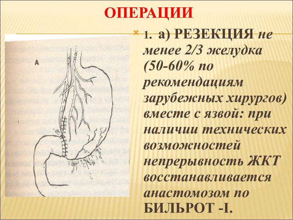 Осложнения желудка 12 перстной кишки. Резекция желудка по поводу язвенной болезни. Резекция желудка операция.