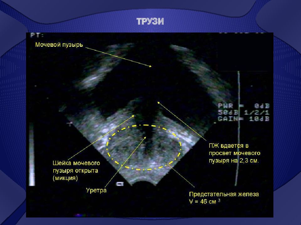 Как делают узи предстательная железа у мужчин в картинках
